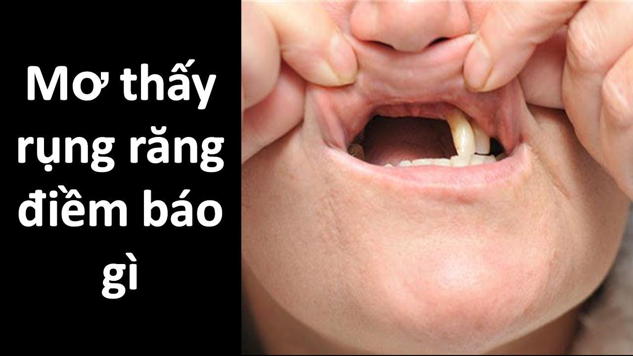 Chuyên gia phân tích giấc mơ răng rụng